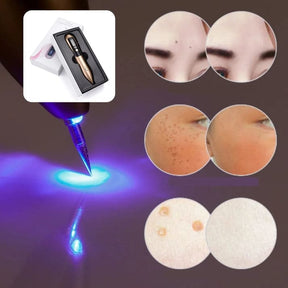 Elimina imperfecciones al instante con el cauterizador